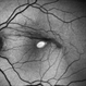 Macular Hole, Autofluorescence Macular Hole, Autofluorescence